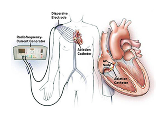 BME802 Catheter Ablation for Atrial Fibrillation: Techniques and Existing Devices
