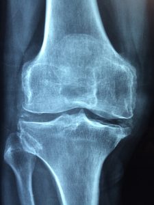 Total Knee Arthroplasty (TKA) Assignment