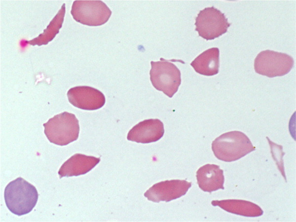 Giemsa-Wright peripheral smear blood - Assignment  Diagnostic Method of Hemolytic anemia Assignment Sample
